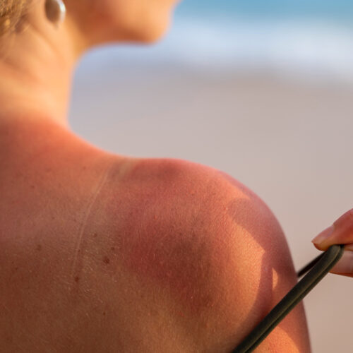 Dicas para se proteger dos danos solares: como evitar queimaduras na pele?