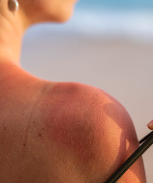 Dicas para se proteger dos danos solares: como evitar queimaduras na pele?